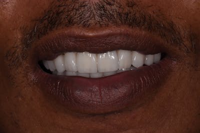 Patient Smile Before & After Gallery - Patient 433435 - Image 2