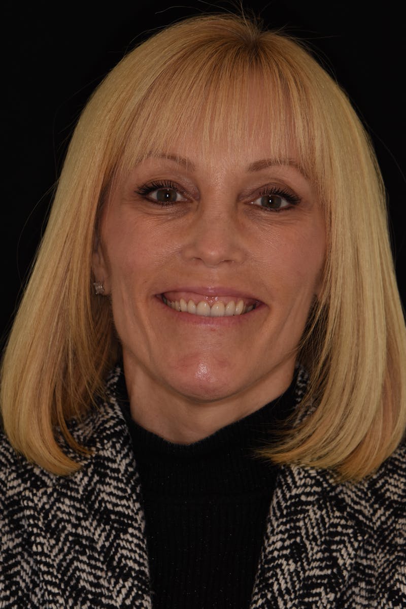 Patient Smile Before & After Gallery - Patient 177555 - Image 1