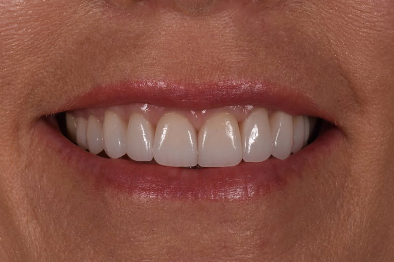 Patient Smile Before & After Gallery - Patient 177555 - Image 4