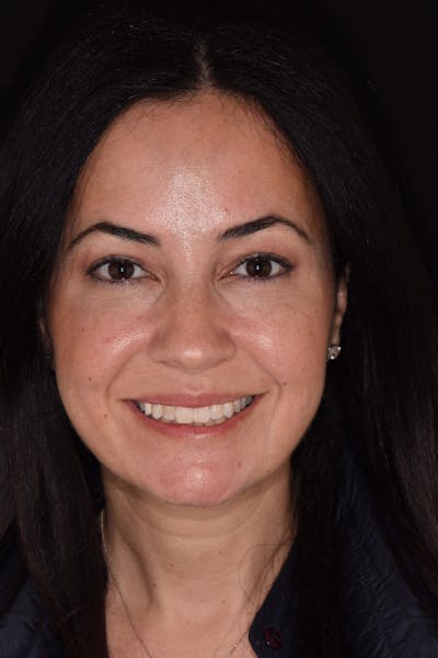 Patient Smile Before & After Gallery - Patient 329345 - Image 1