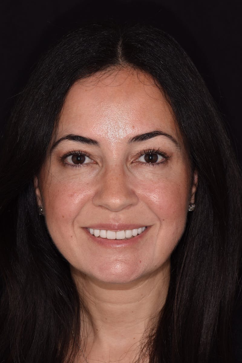 Patient Smile Before & After Gallery - Patient 329345 - Image 2