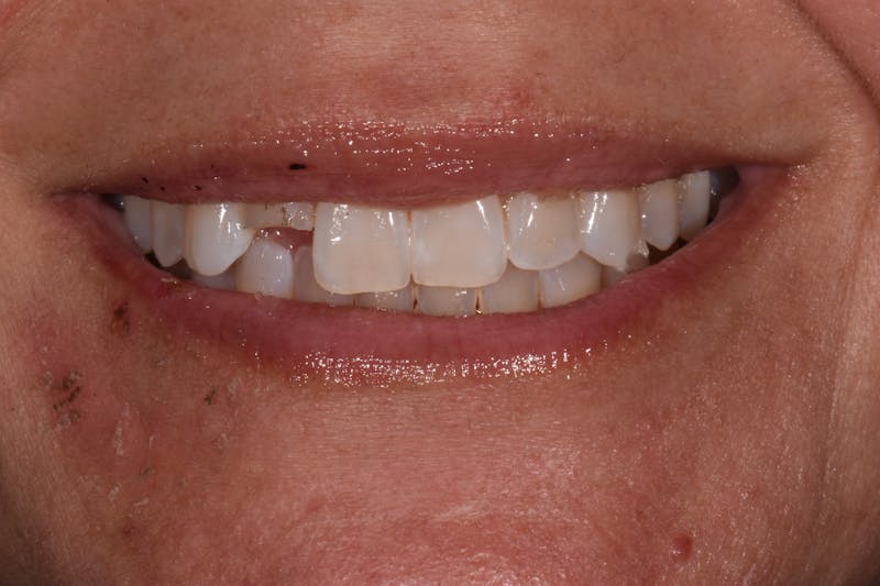 Patient Smile Before & After Gallery - Patient 329345 - Image 3