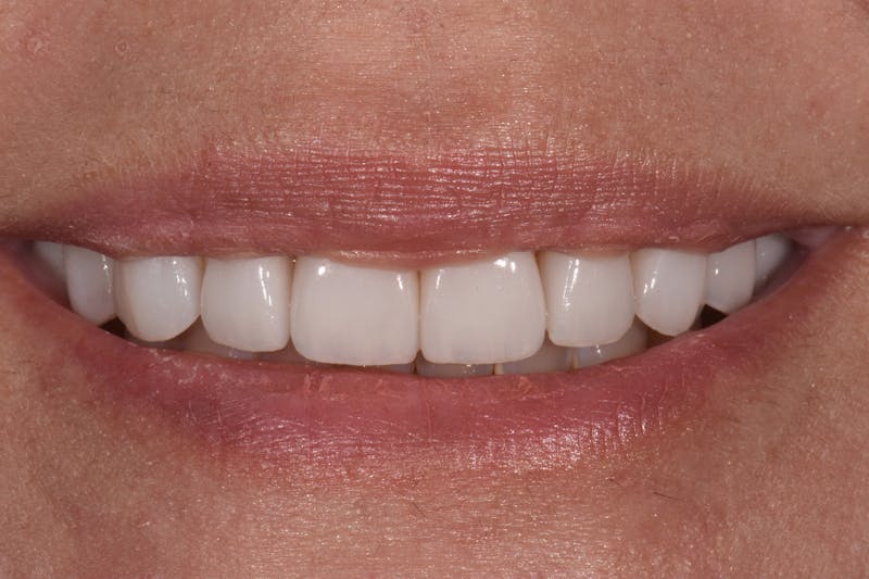 Patient Smile Before & After Gallery - Patient 329345 - Image 4