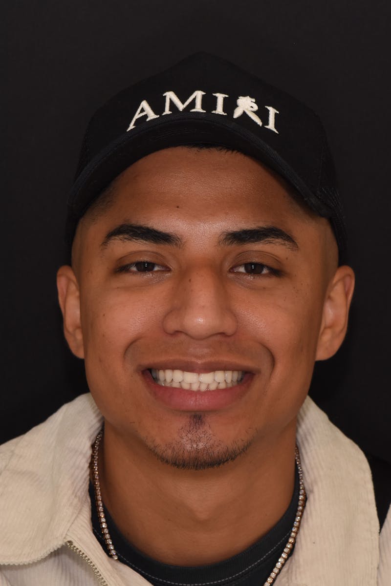 Patient Smile Before & After Gallery - Patient 797004 - Image 1