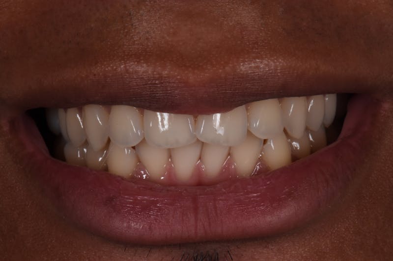 Patient Smile Before & After Gallery - Patient 797004 - Image 3
