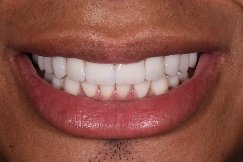 Patient Smile Before & After Gallery - Patient 797004 - Image 4