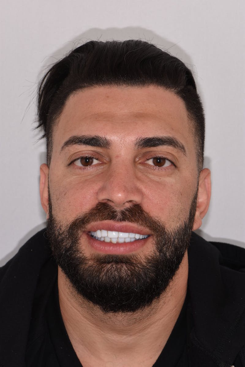 Patient Smile Before & After Gallery - Patient 237188 - Image 1