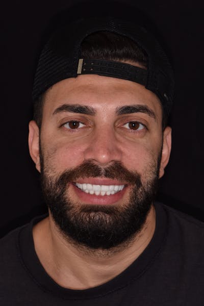 Patient Smile Before & After Gallery - Patient 237188 - Image 2