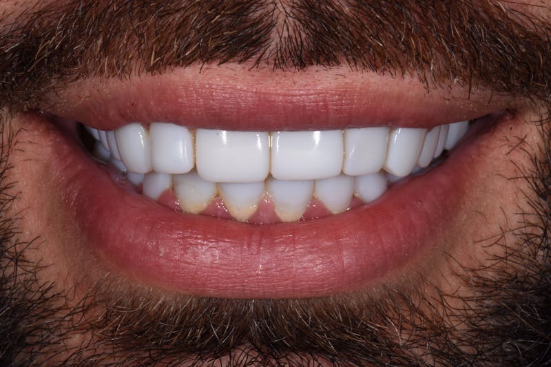 Patient Smile Before & After Gallery - Patient 237188 - Image 3