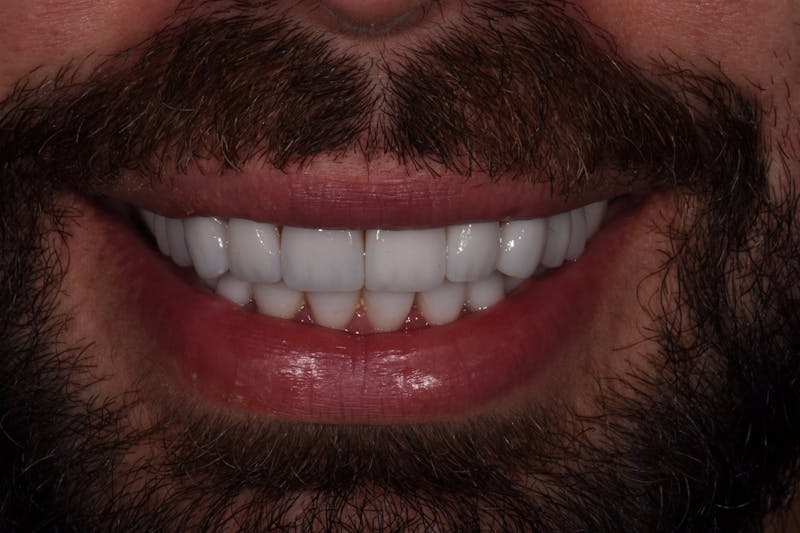Patient Smile Before & After Gallery - Patient 237188 - Image 4