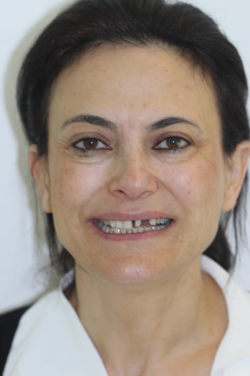 Patient Smile Before & After Gallery - Patient 239446 - Image 1