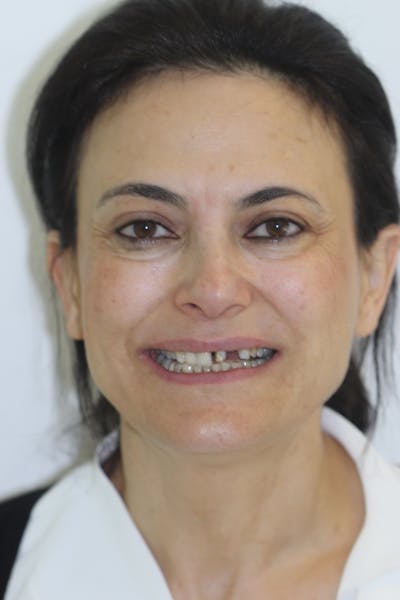 Patient Smile Before & After Gallery - Patient 239446 - Image 1