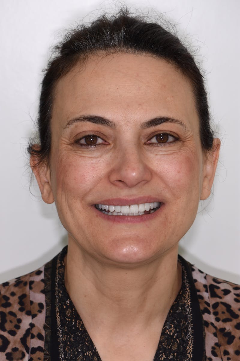 Patient Smile Before & After Gallery - Patient 239446 - Image 2