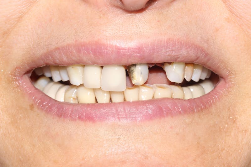 Patient Smile Before & After Gallery - Patient 239446 - Image 3