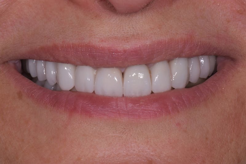 Patient Smile Before & After Gallery - Patient 239446 - Image 4