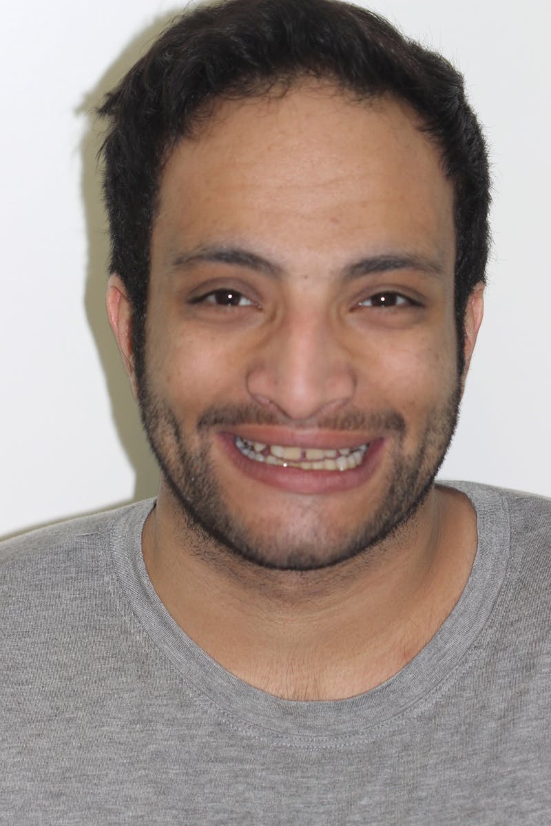 Patient Smile Before & After Gallery - Patient 114888 - Image 1