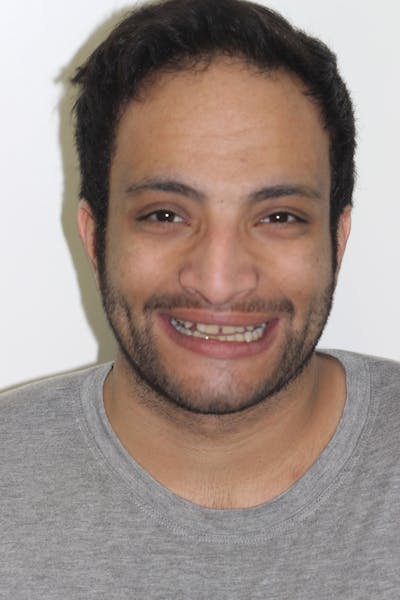 Patient Smile Before & After Gallery - Patient 114888 - Image 1