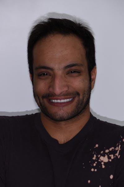 Patient Smile Before & After Gallery - Patient 114888 - Image 2