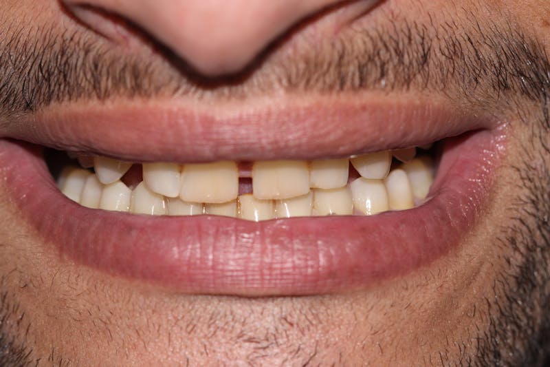 Patient Smile Before & After Gallery - Patient 114888 - Image 3