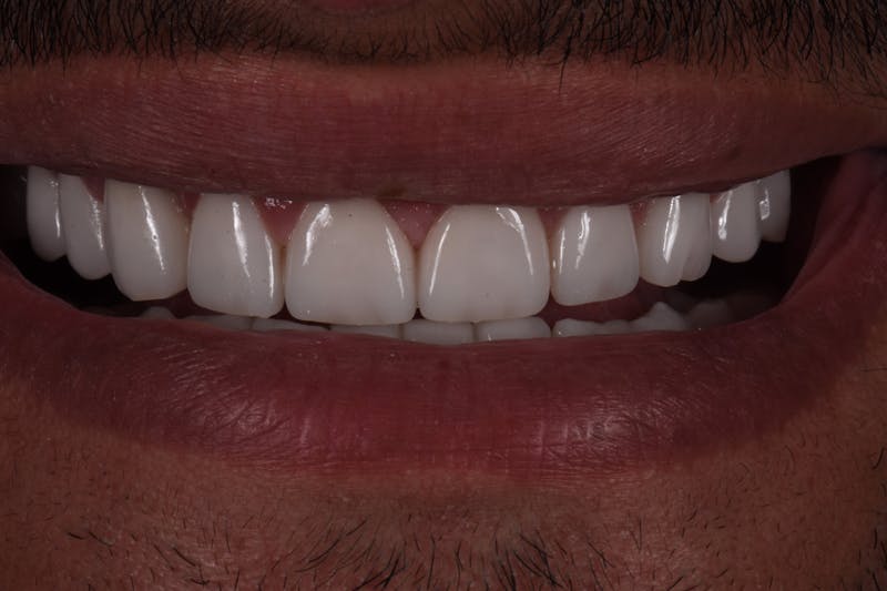 Patient Smile Before & After Gallery - Patient 114888 - Image 4