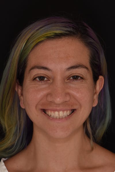 Patient Smile Before & After Gallery - Patient 375602 - Image 1