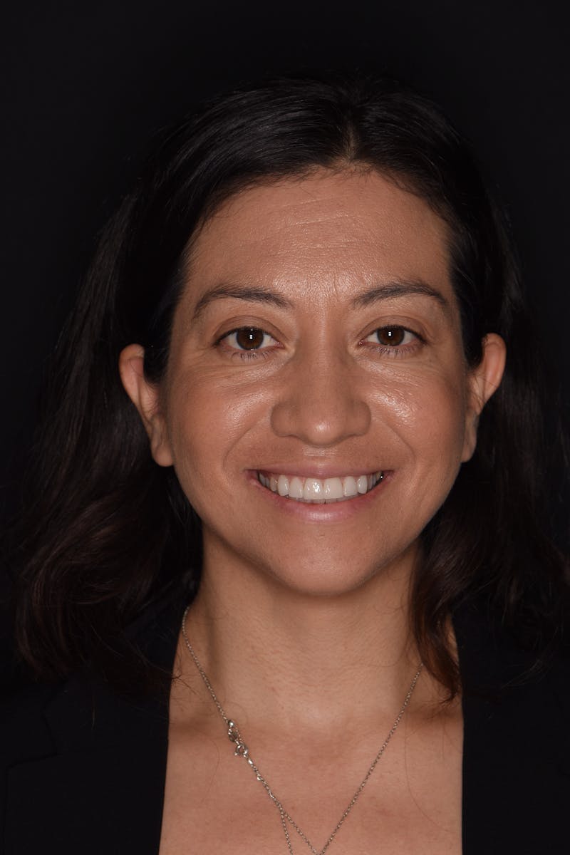 Patient Smile Before & After Gallery - Patient 375602 - Image 2