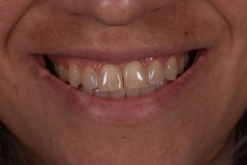 Patient Smile Before & After Gallery - Patient 375602 - Image 3