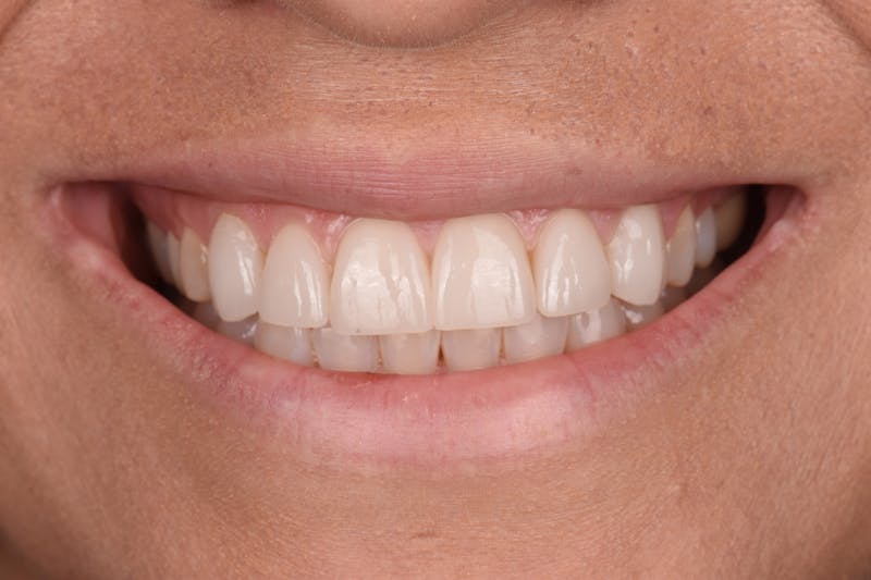 Patient Smile Before & After Gallery - Patient 375602 - Image 4
