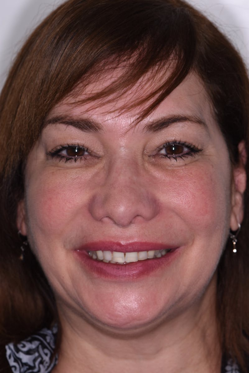 Patient Smile Before & After Gallery - Patient 163936 - Image 1