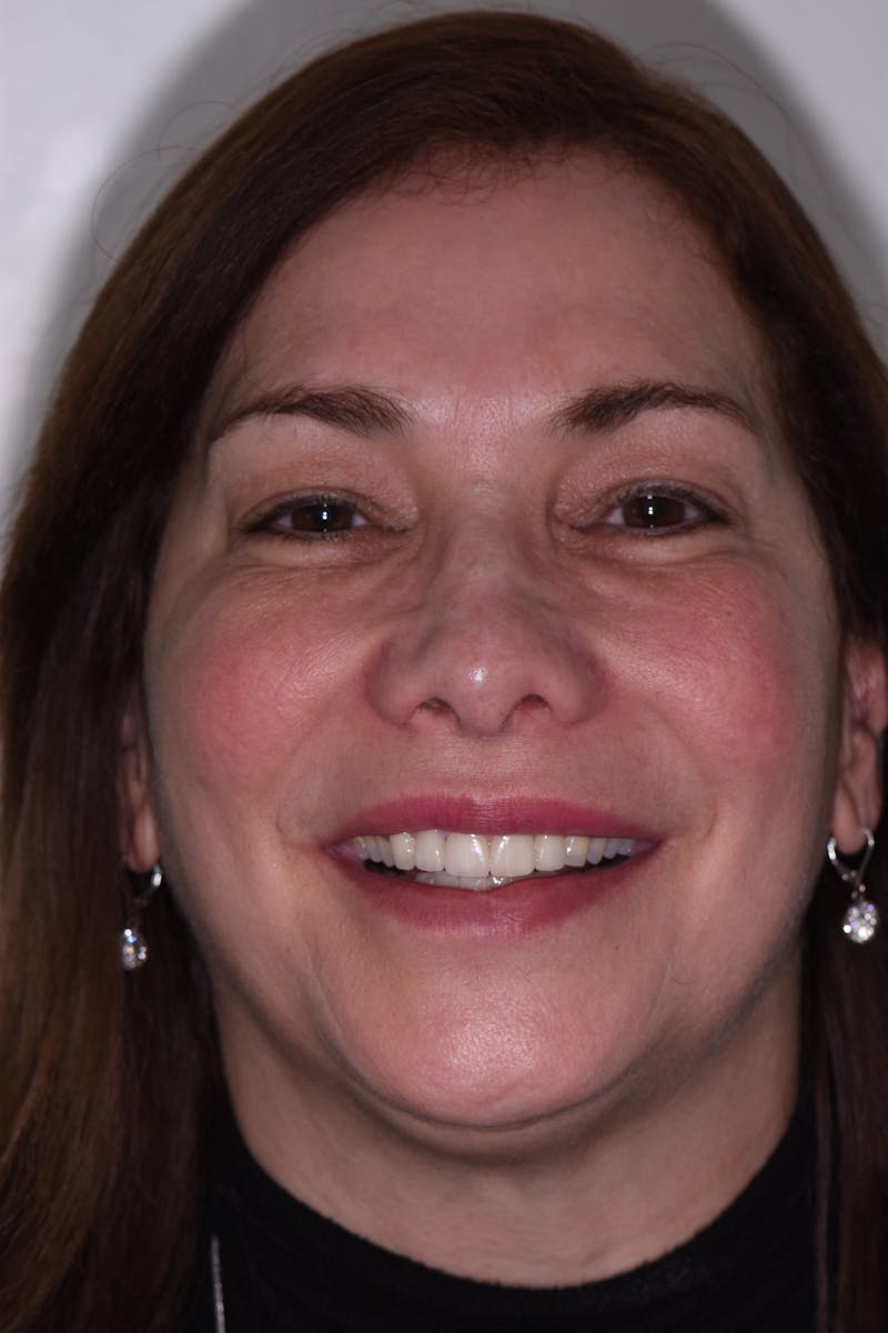 Patient Smile Before & After Gallery - Patient 163936 - Image 2