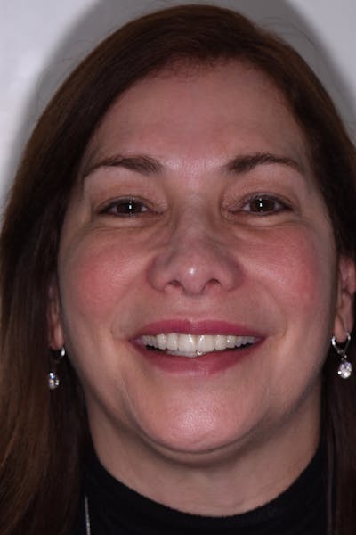 Patient Smile Before & After Gallery - Patient 163936 - Image 2