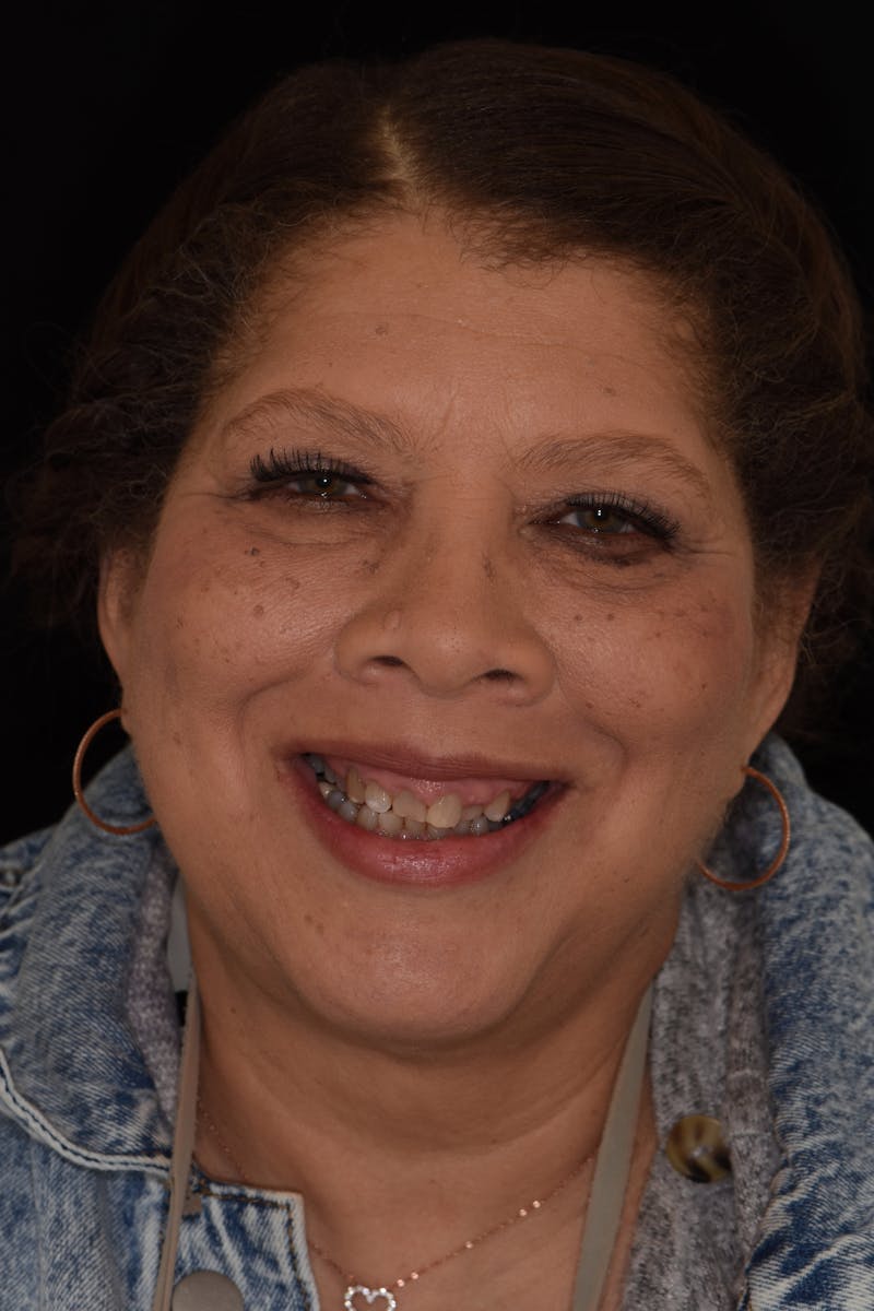 Patient Smile Before & After Gallery - Patient 274593 - Image 1