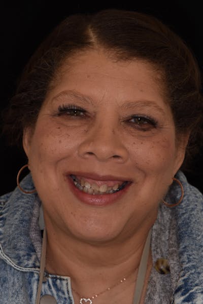 Patient Smile Before & After Gallery - Patient 274593 - Image 1