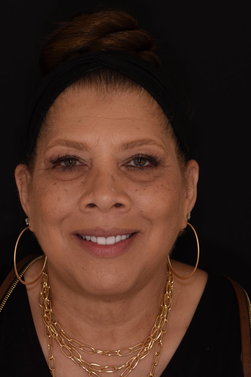 Patient Smile Before & After Gallery - Patient 274593 - Image 2