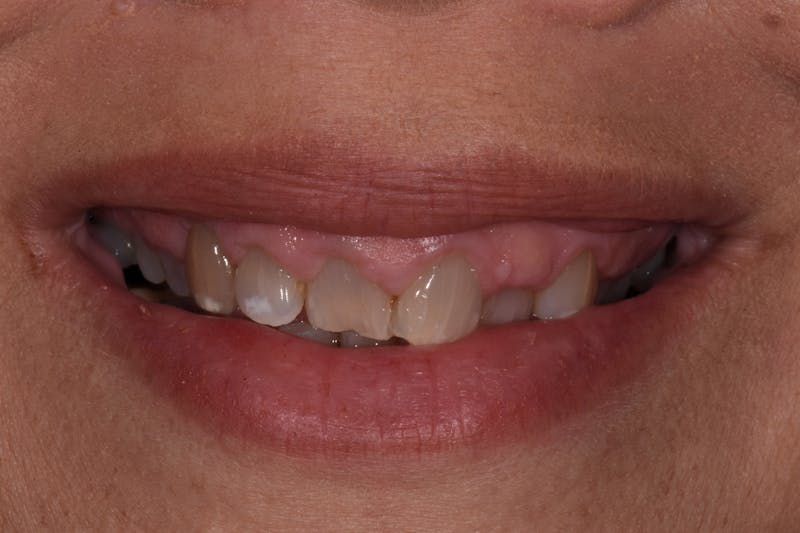 Patient Smile Before & After Gallery - Patient 274593 - Image 3