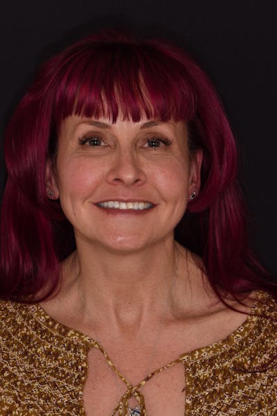 Patient Smile Before & After Gallery - Patient 304255 - Image 1