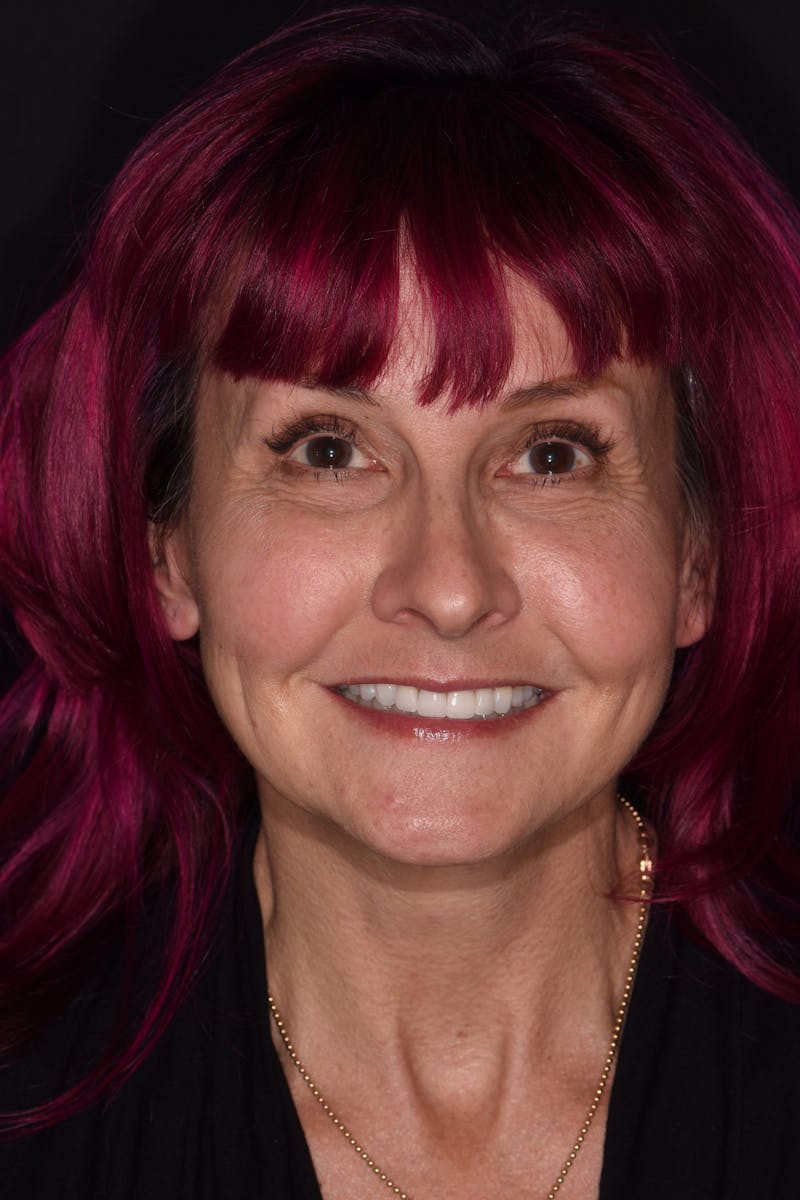 Patient Smile Before & After Gallery - Patient 304255 - Image 2