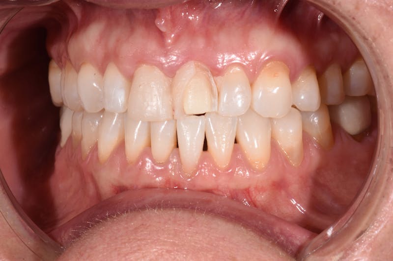 Patient Smile Before & After Gallery - Patient 304255 - Image 3