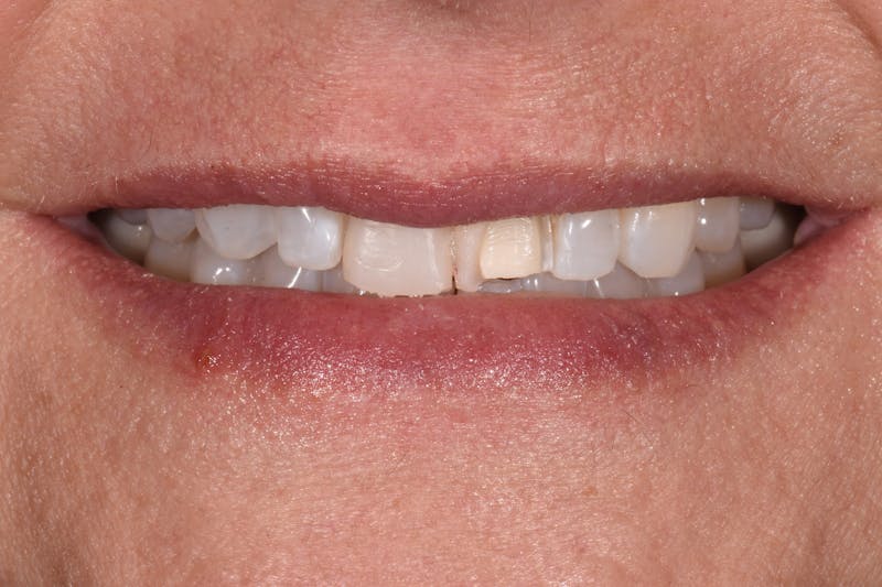 Patient Smile Before & After Gallery - Patient 304255 - Image 5