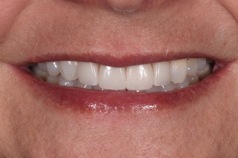 Patient Smile Before & After Gallery - Patient 304255 - Image 6