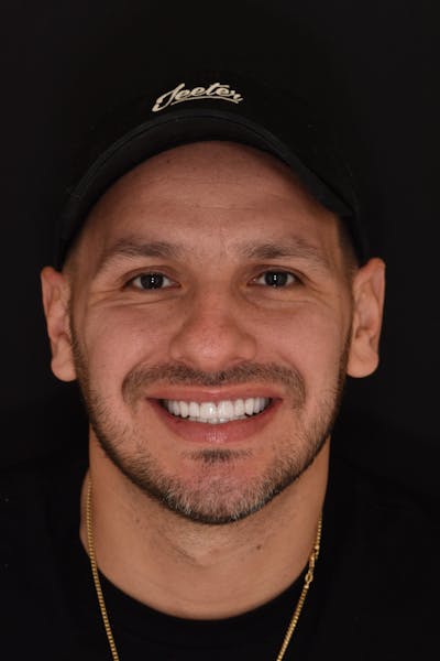 Patient Smile Before & After Gallery - Patient 381470 - Image 2