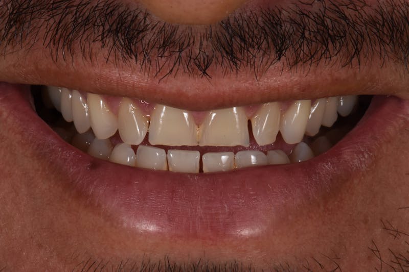 Patient Smile Before & After Gallery - Patient 381470 - Image 3