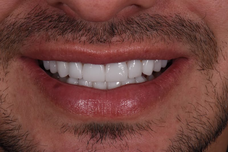 Patient Smile Before & After Gallery - Patient 381470 - Image 4