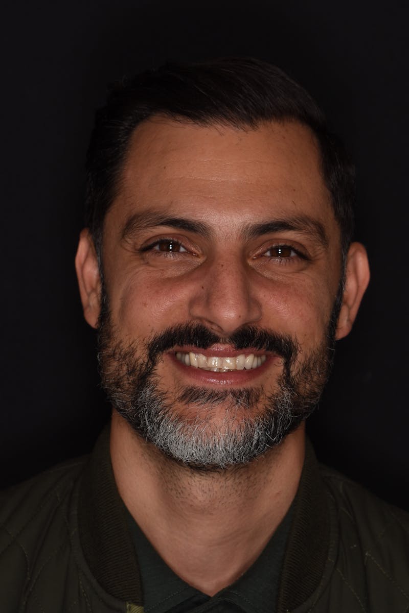 Patient Smile Before & After Gallery - Patient 177353 - Image 1