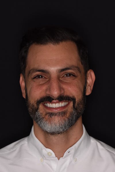 Patient Smile Before & After Gallery - Patient 177353 - Image 2