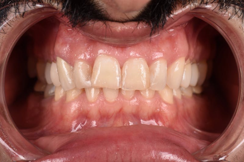 Patient Smile Before & After Gallery - Patient 177353 - Image 3