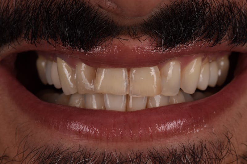 Patient Smile Before & After Gallery - Patient 177353 - Image 5