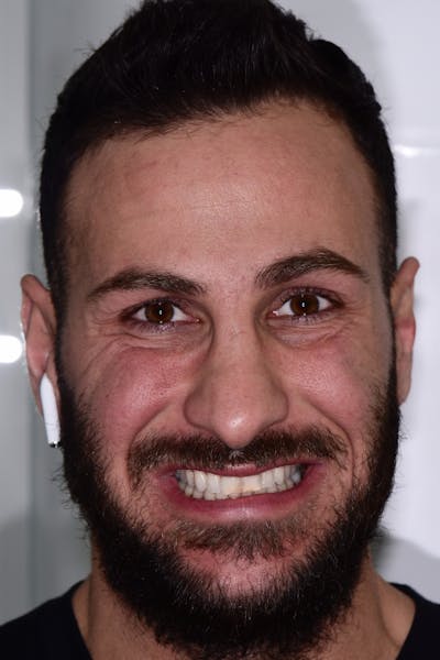 Patient Smile Before & After Gallery - Patient 175670 - Image 1