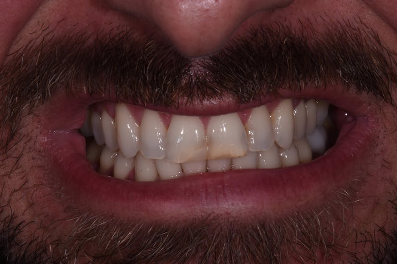 Patient Smile Before & After Gallery - Patient 175670 - Image 3