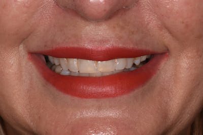 Patient Smile Before & After Gallery - Patient 150554 - Image 1